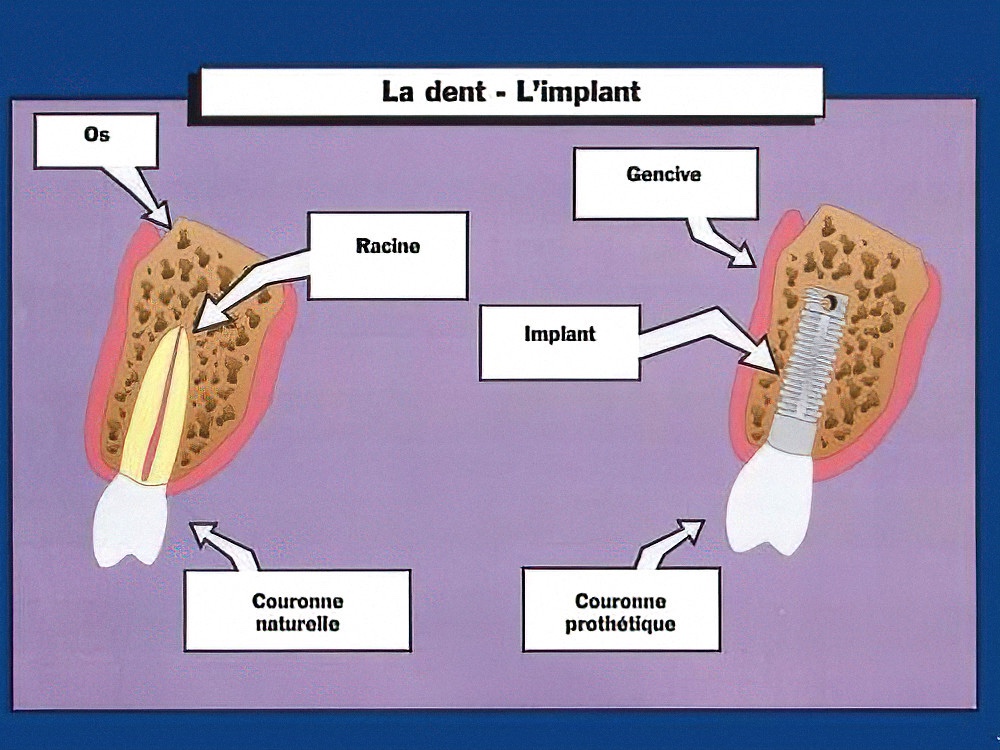 Différences entre dents et implants